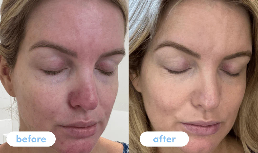 Collagen soap transforming skin with visible improvements in texture and radiance.