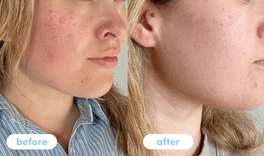 Before and after photos showcasing the benefits of collagen soap for skin rejuvenation.